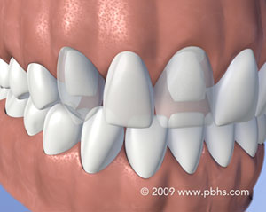 An example of a dental fixed bridge