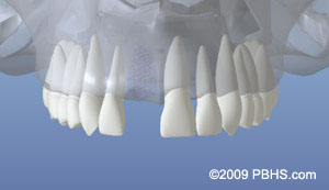 A representation of a healed upper jaw bone after losing a tooth