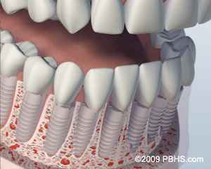 A mouth showing the lower jaw with all the teeth as individual implants