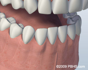 A mouth showing the healed lower jaw after individual implants were placed