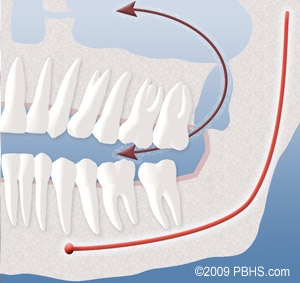 A diagram showing the opening that can occur between your mouth and sinuses