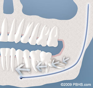 An Implant Retained Upper Denture with its implants attached