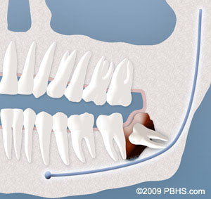 An Implant Retained Upper Denture with its implants attached