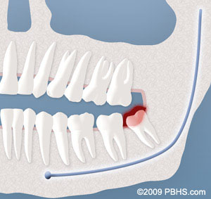 An Implant Retained Upper Denture with its implants attached